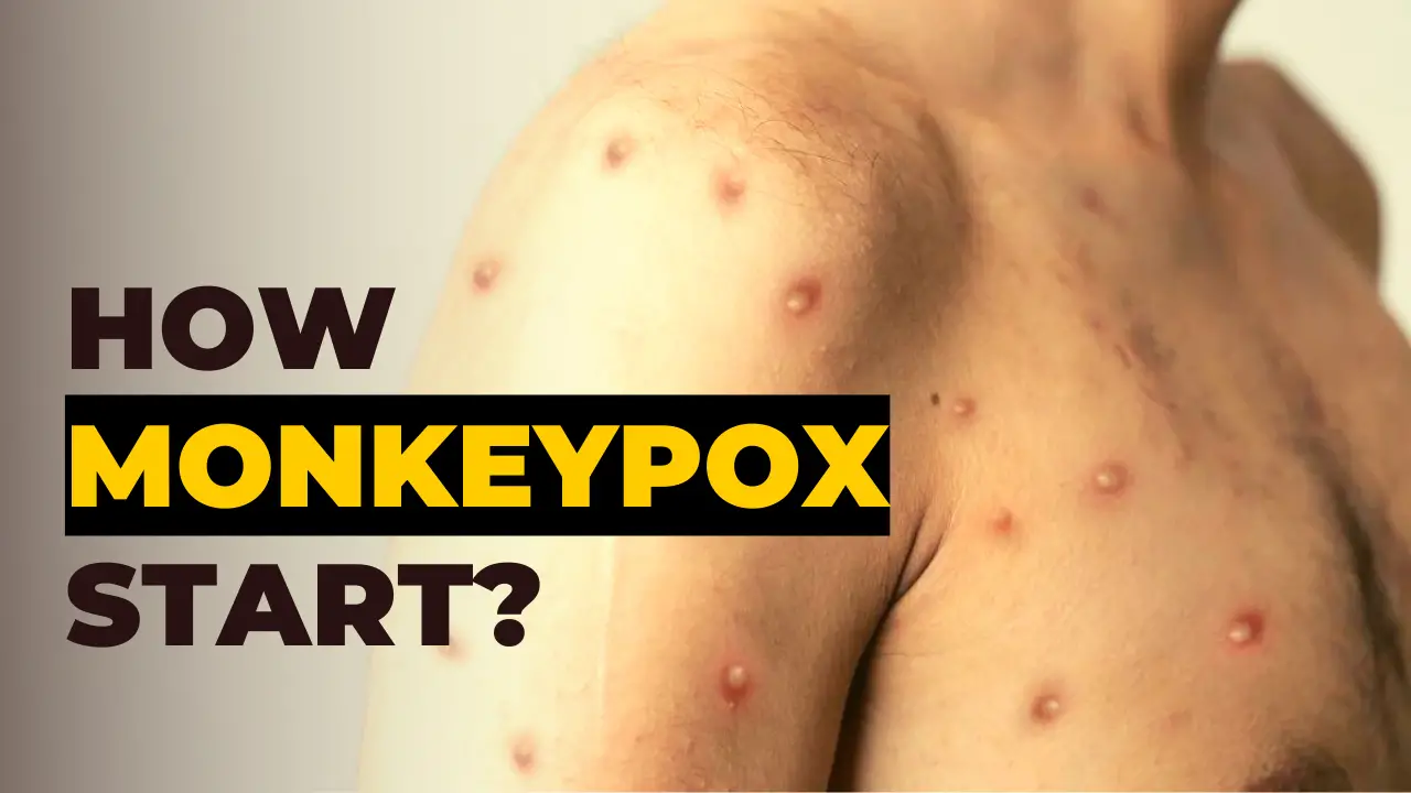 history monkeypox outbreak