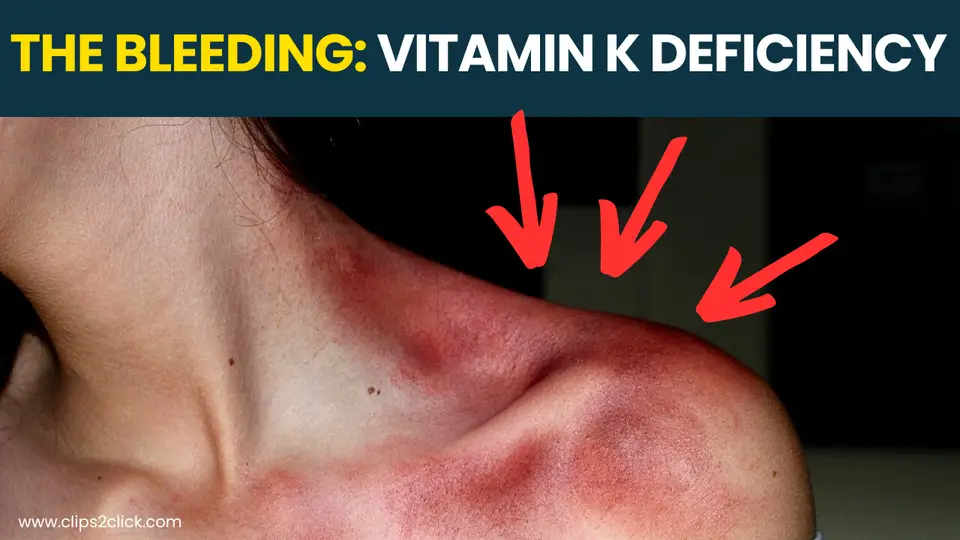 Vitamin K Deficiency Symptoms: Recognizing the Signs of This Dangerous Bleeding Disorder