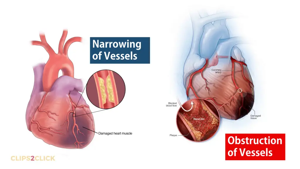 Ischemic Heart Disease explain