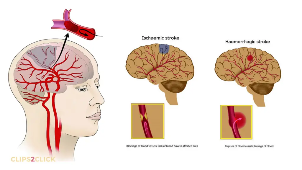 Stroke main 2 types