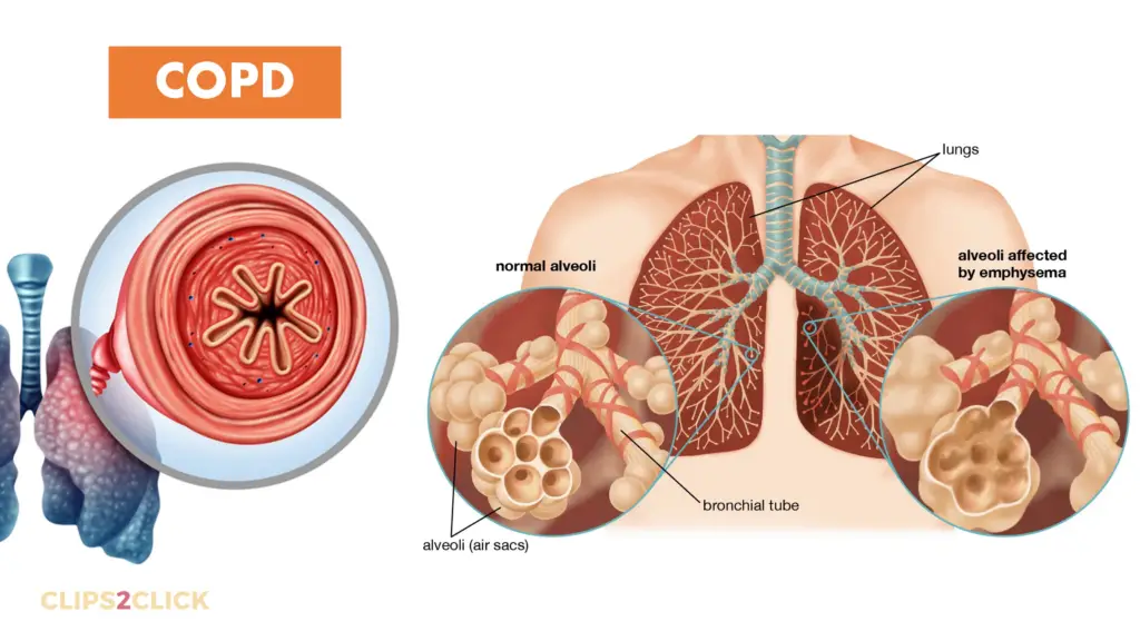 Chronic Obstructive Pulmonary Disease COPD