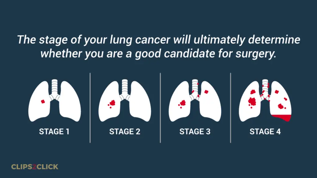 Trachea, Bronchus, and Lung Cancers stages