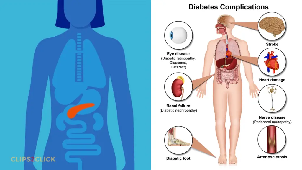 Diabetes Mellitus complications