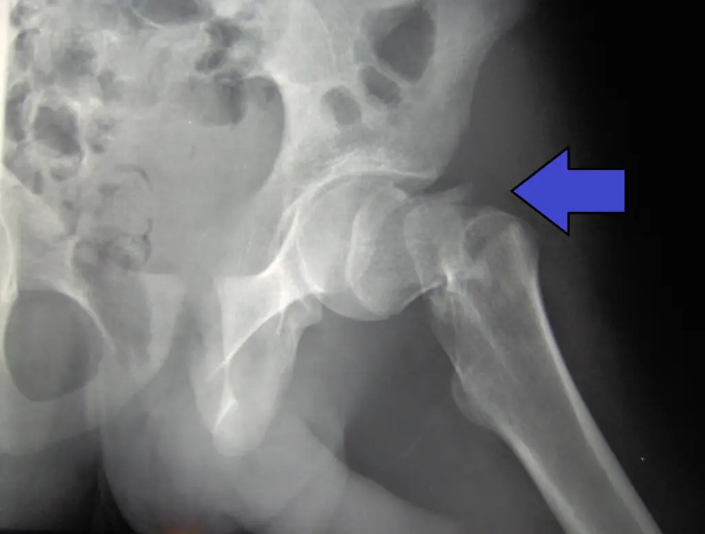 Greater Bone Fracture Risk 