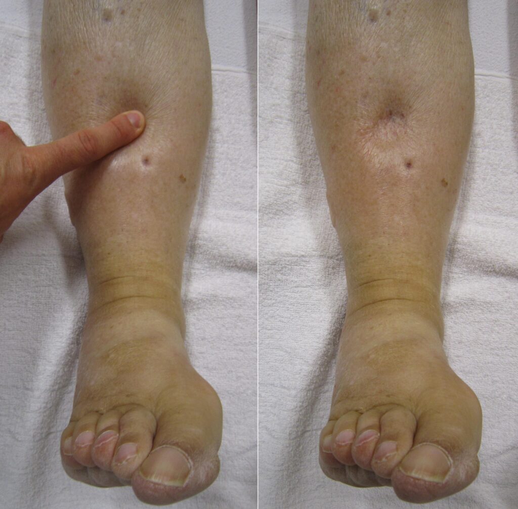 Swelling or Edema