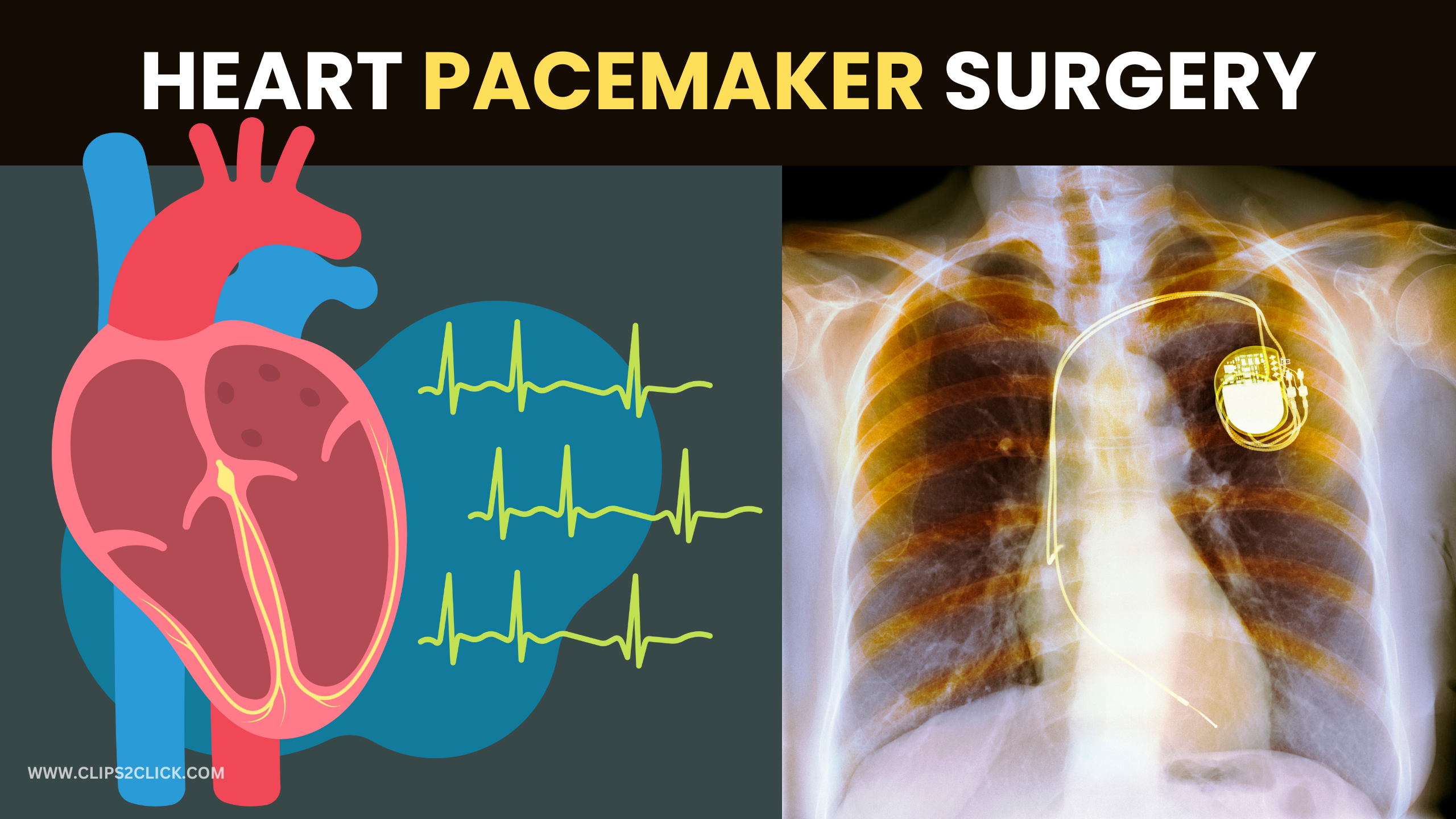 Heart Pacemaker Surgery: A Comprehensive Guide