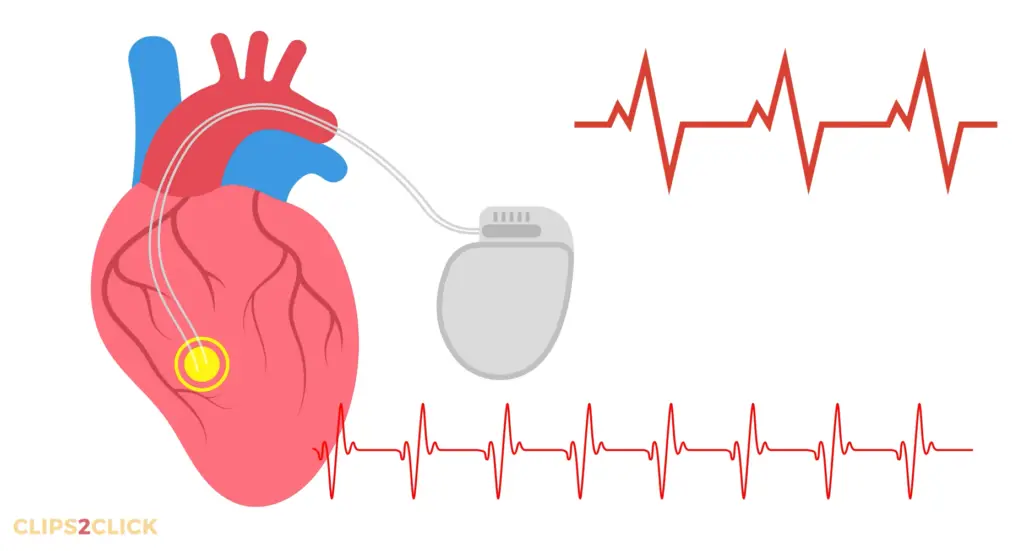 What Does a Pacemaker Do?
