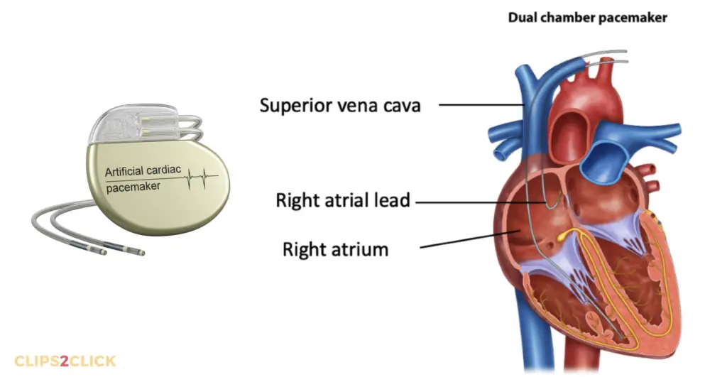 Dual-chamber pacemakers