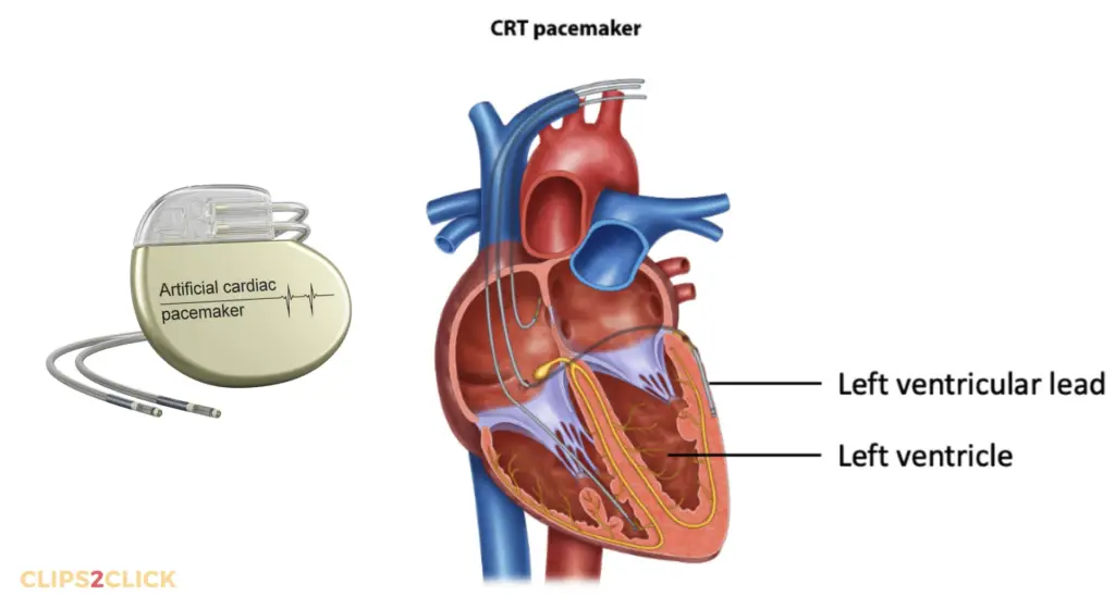 Biventricular pacemakers 