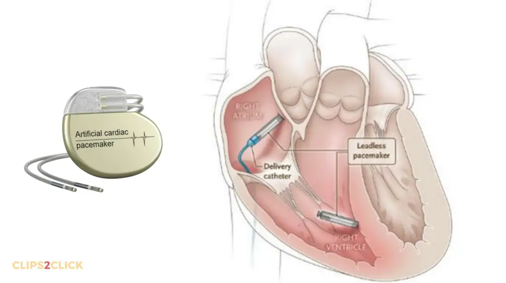 Heart Pacemaker Surgery: A Comprehensive Guide