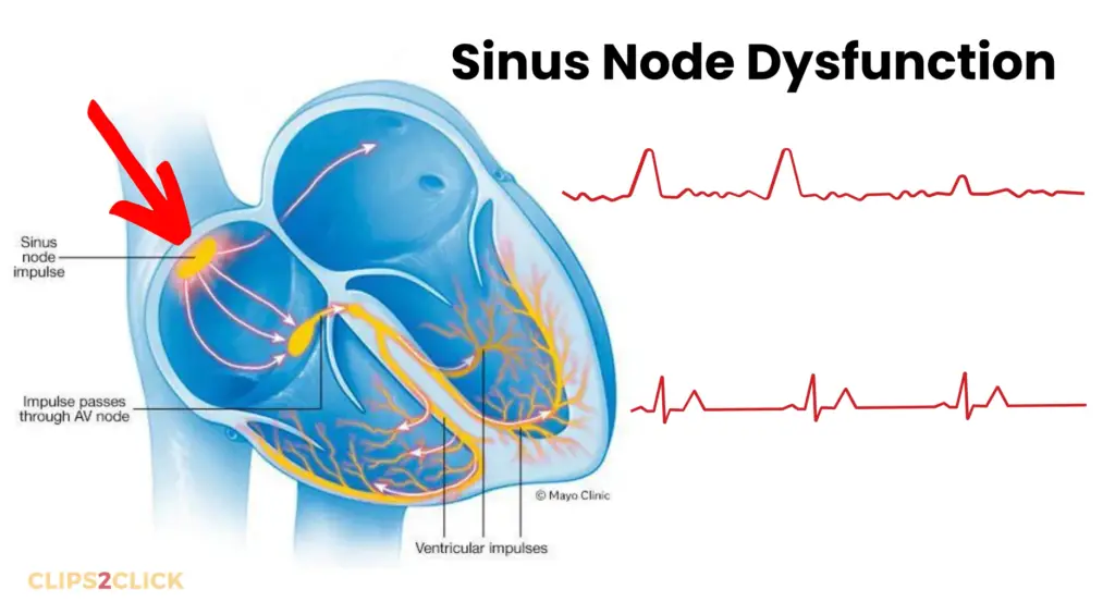 sinus nodal dysfunction