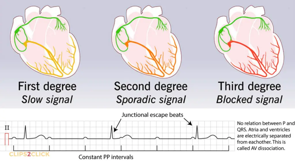 Heart Pacemaker Surgery: A Comprehensive Guide