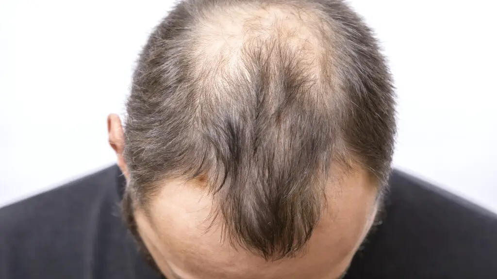 Hair Loss Treatment: Understanding Your Options