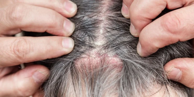 Hair Loss and Itchy Scalp