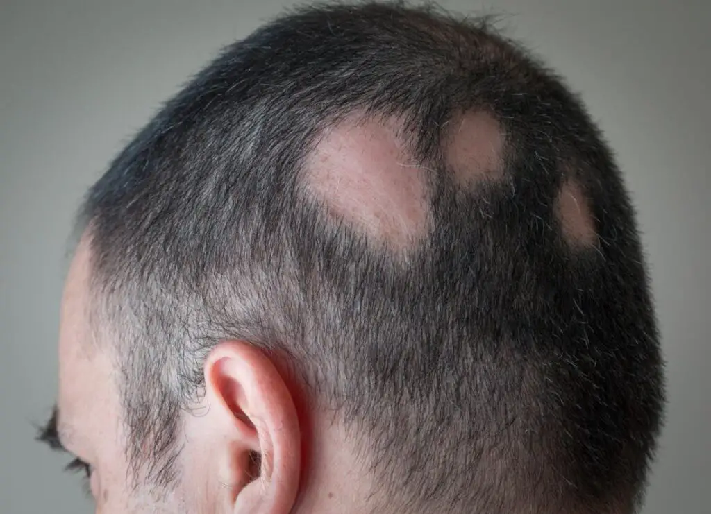 Alopecia areata