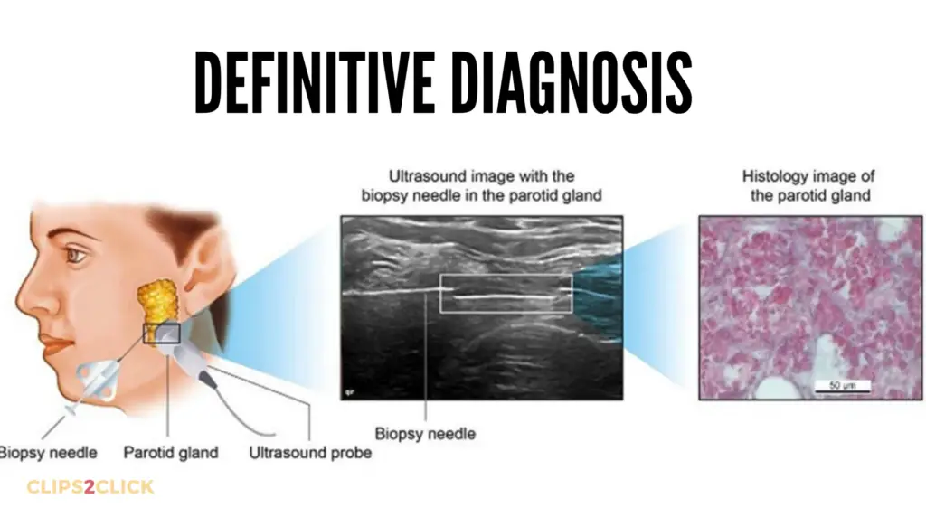 Salivary Gland Cancer Diagnosed