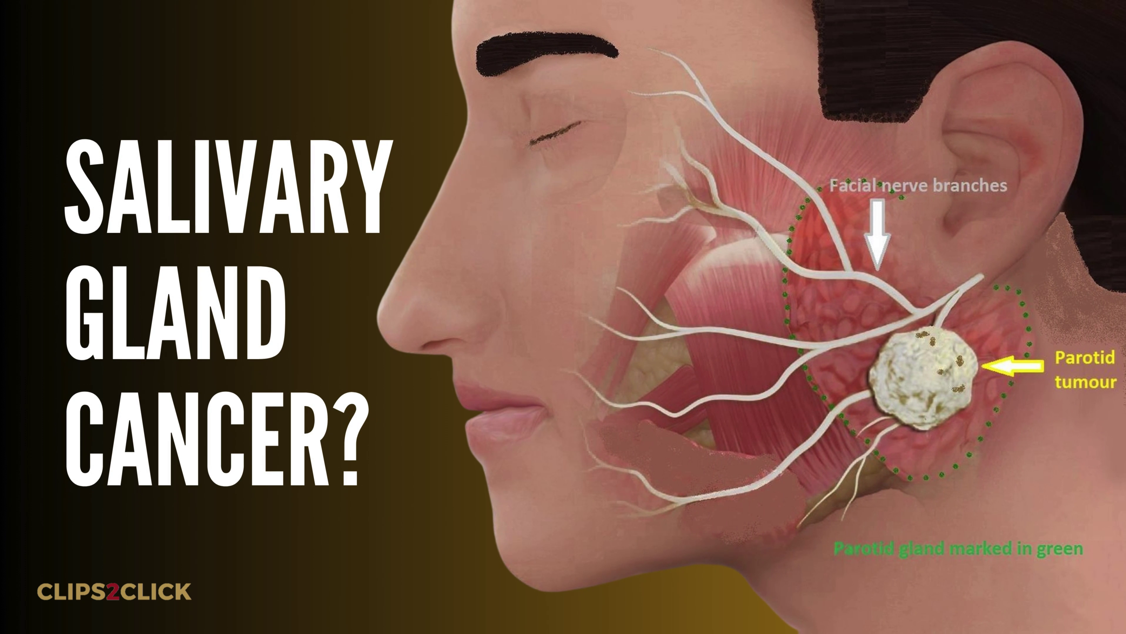 Salivary Gland Cancer: Symptoms, Causes, and Treatment